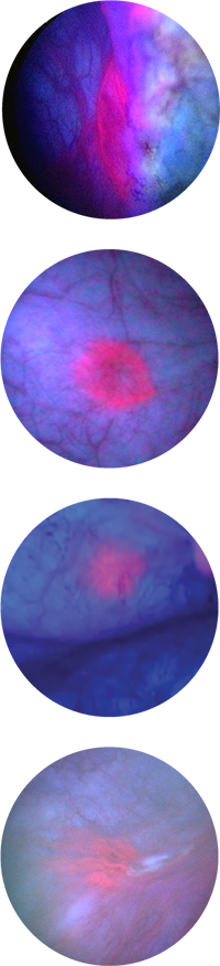 white vs blue light cystoscopy images of bladder cancer