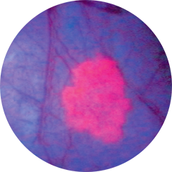 blue light cystoscopy with Cysview image of bladder cancer